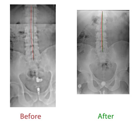 Chiropractic Lutz FL Spine X-ray