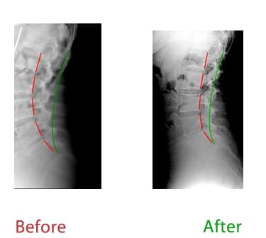 Chiropractic Lutz FL Straight Neck X-ray